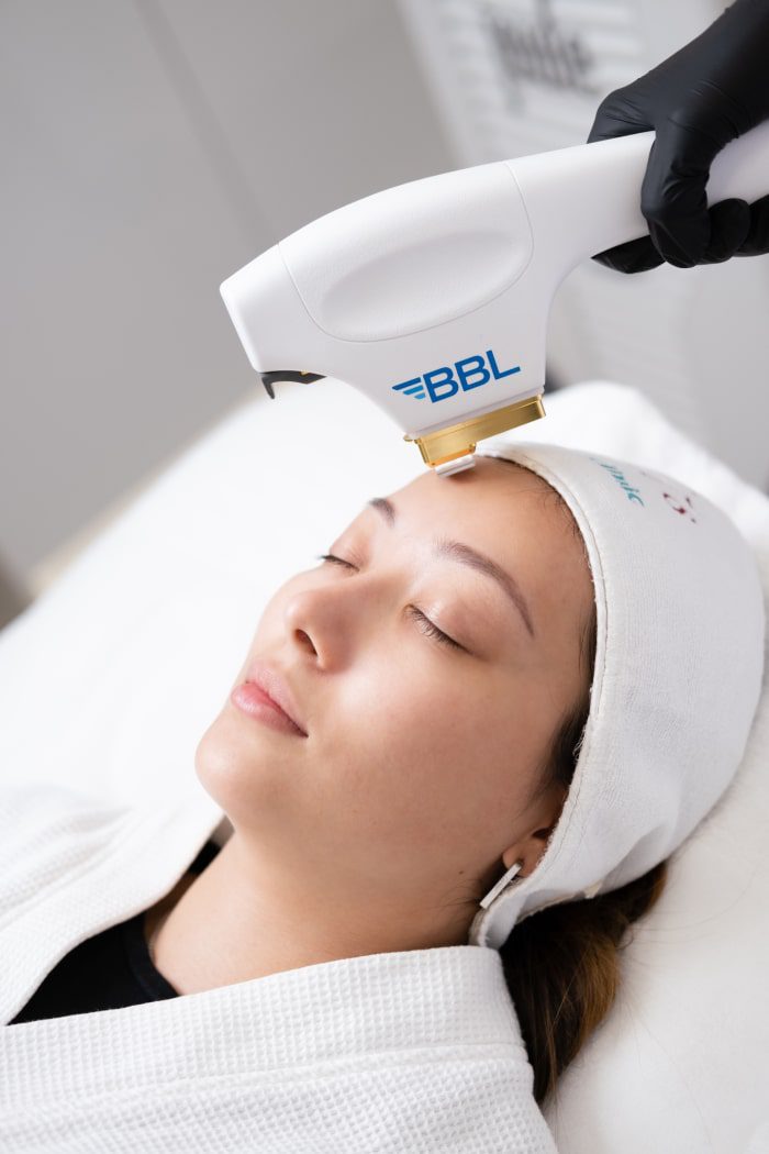 BBL Facial Treatment