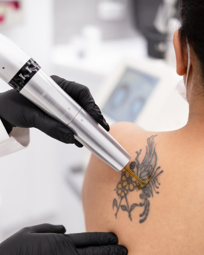 Laser Tattoo Removal in Treatment in Dubai