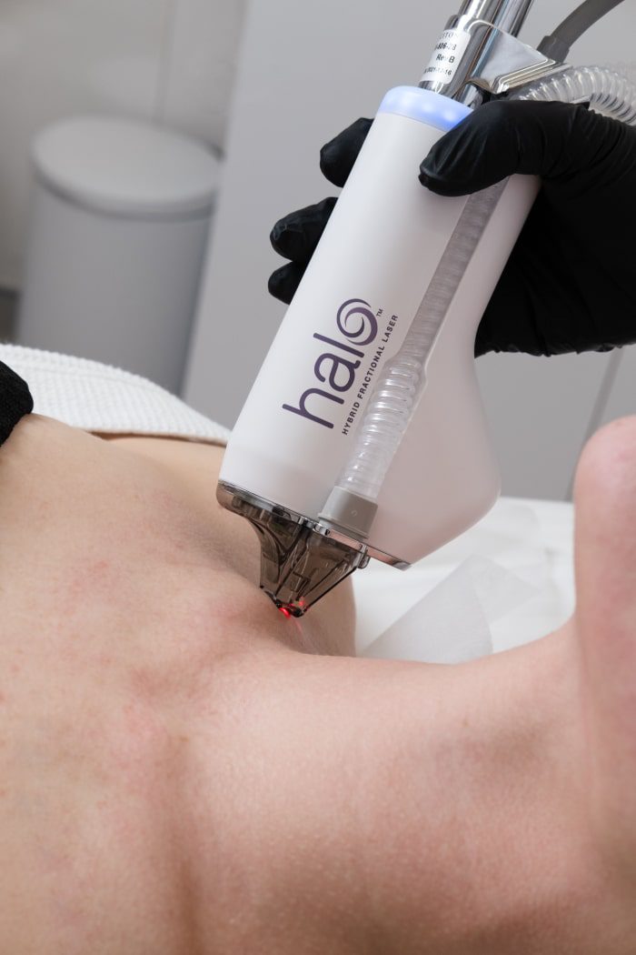 Halo Laser Skin Treatment